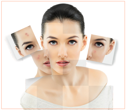 Psoriasis Decoded